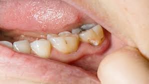 दांतों को ही नहीं, मसूड़ों को भी खराब कर देती हैं 5 चीजें, बचकर रहना है जरूरी