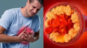 दिल-दिमाग के लिए खतरनाक है बैड कोलेस्ट्रॉल, खाने के अलावा भी कई चीजें बढ़ाती हैं LDL